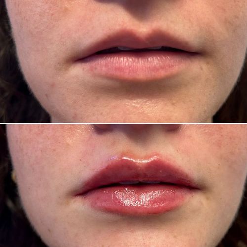 0 5 Ml Lip Filler Before And After Yorkshire Skin Center 0 5 Ml Lip Filler Before And After Yorkshire Skin Center