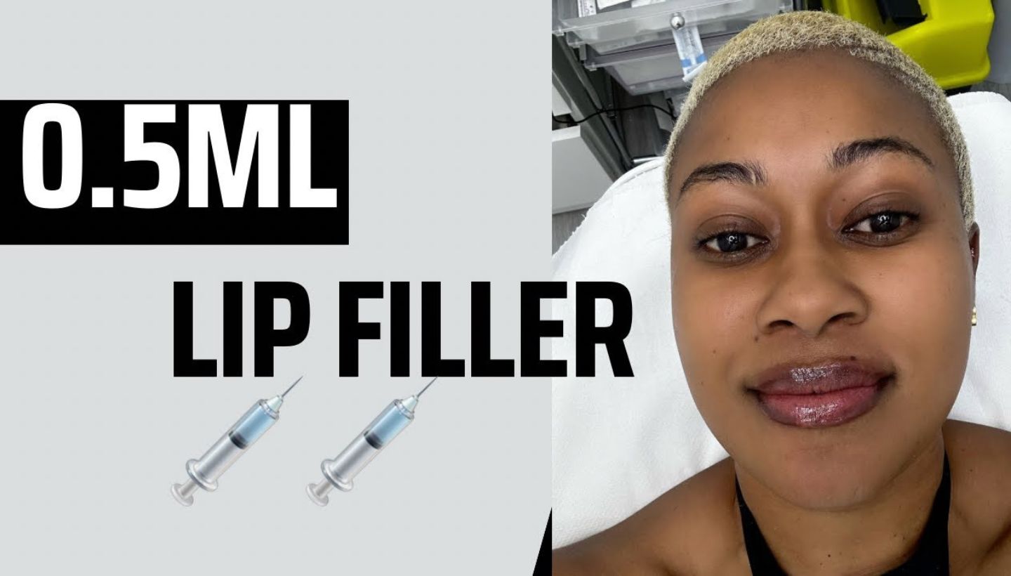 How Long Does 0.5 mL Lip Filler Last?