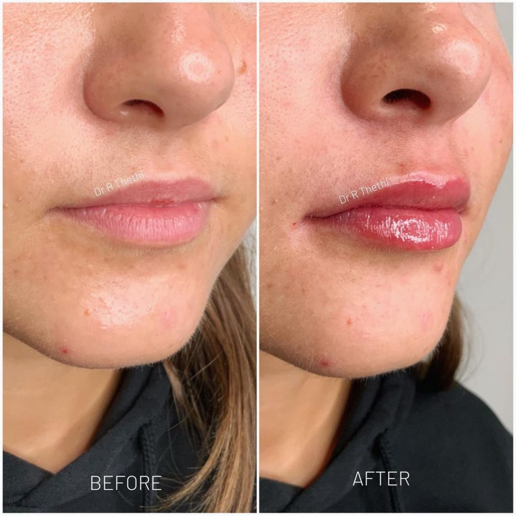 0 5 Ml Lip Filler Before And After Yorkshire Skin Center 0 5 Ml Lip Filler Before And After Yorkshire Skin Center