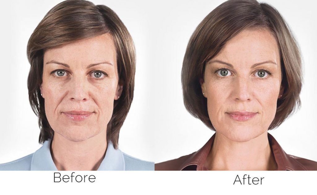 Sculptra before & after result