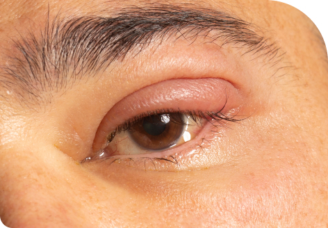upper eyelid5