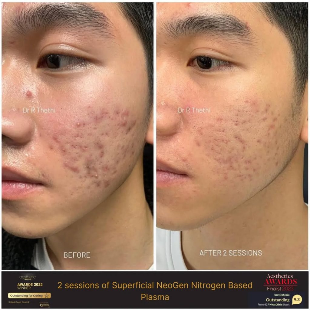 Neogen Plasma treatment Result on Acne Scarring