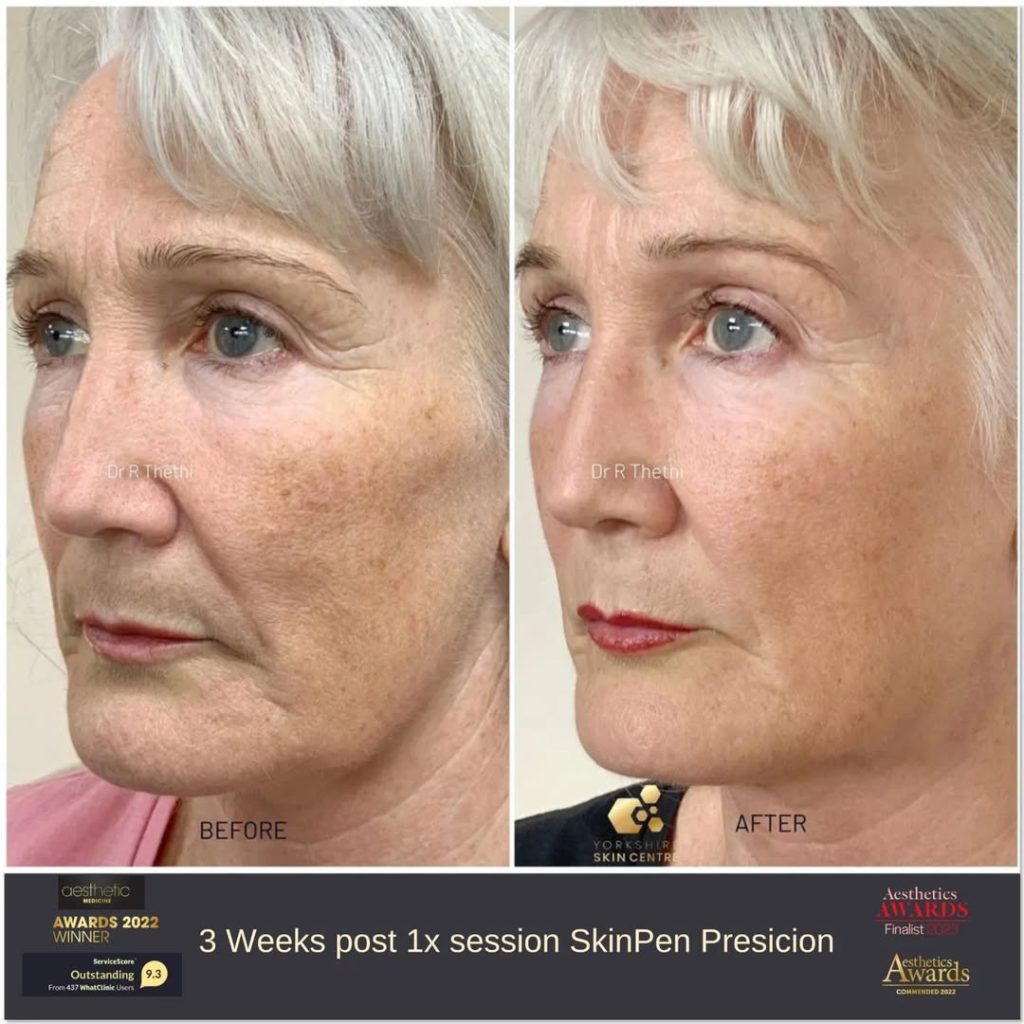 Pigmentation Treatment Result By Dr Raj