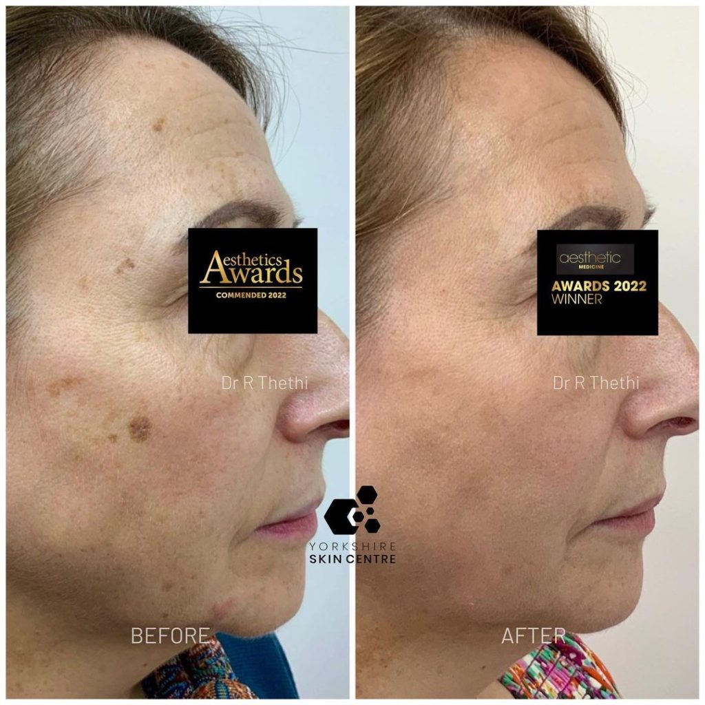 Pigmentation Treatment Result By Yorkshire Skin Centre