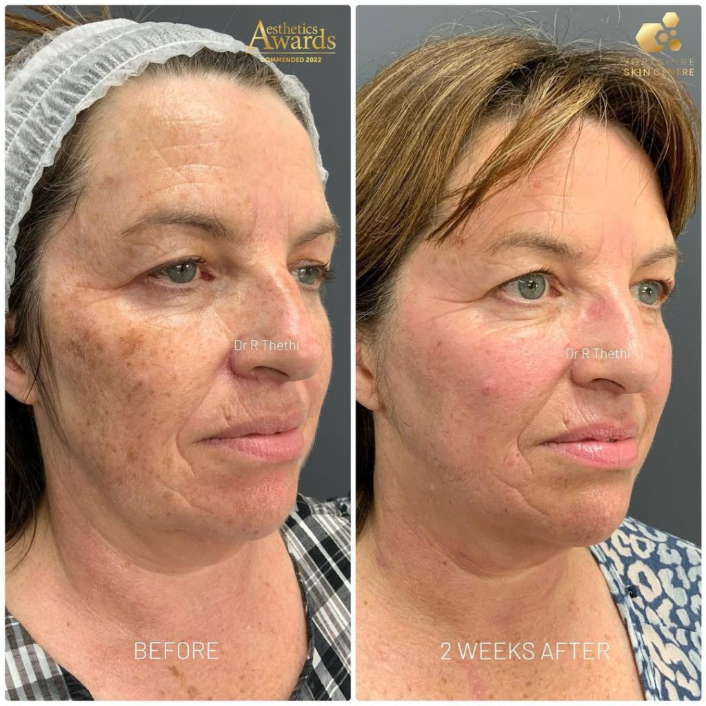 Pigmentation removal by Yorkshire skin centre