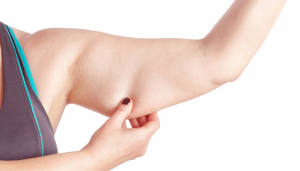 Flabby arms