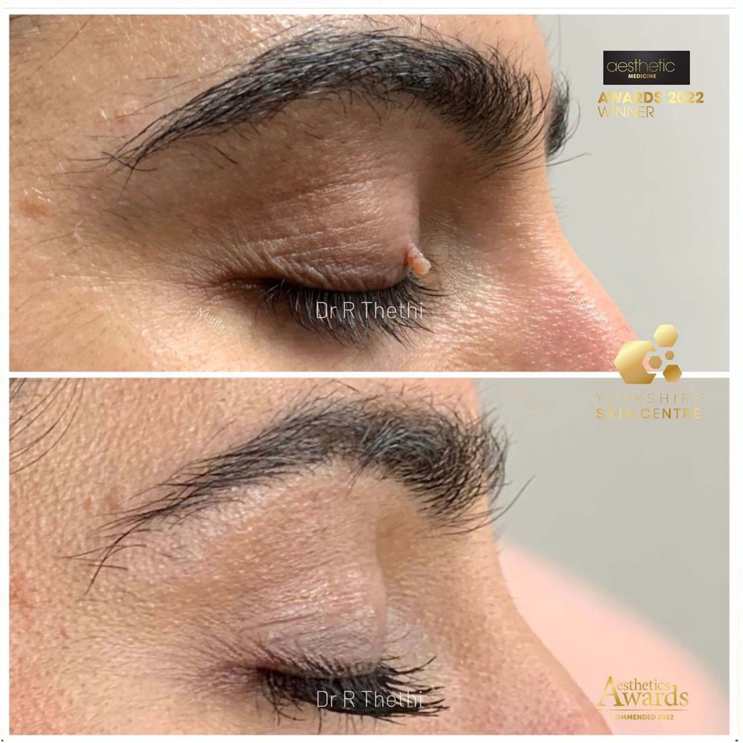 Mole Removal Before & After