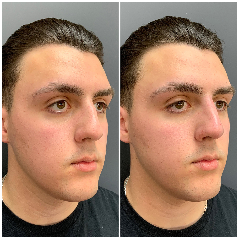 Nose fillers before & after