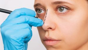 Crooked Nose treatment