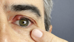 How long do Chalazion Last