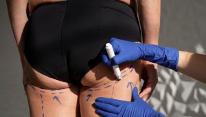 Ozempic Butt Treatment
