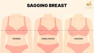 Sagging Breasts