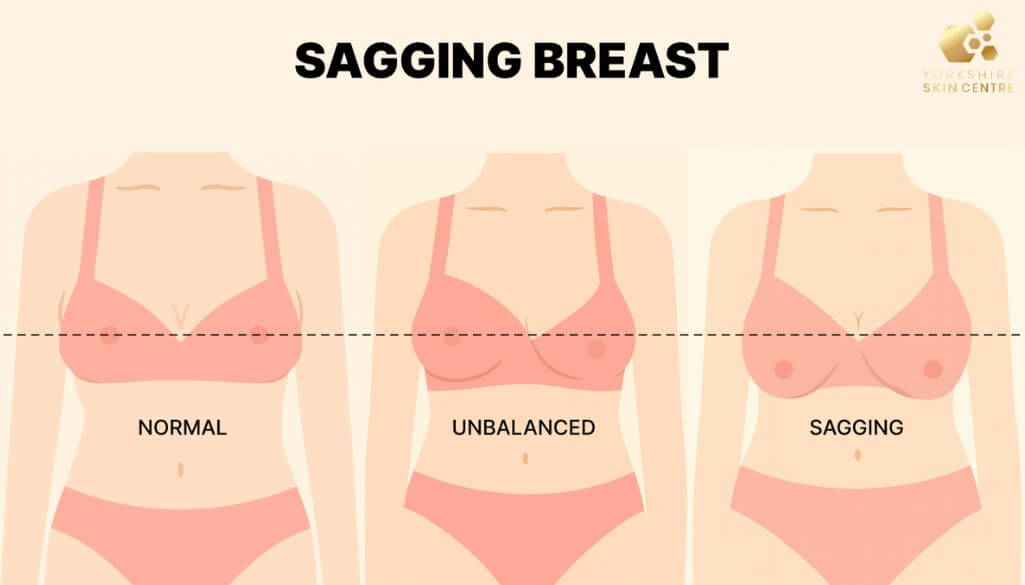 Sagging Breasts: Everything You Need To Know About Breast Ptosis