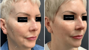 How Long Does Chin Fillers Last