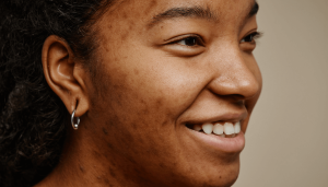 Hyperpigmentation Laser Treatment For Dark Skin