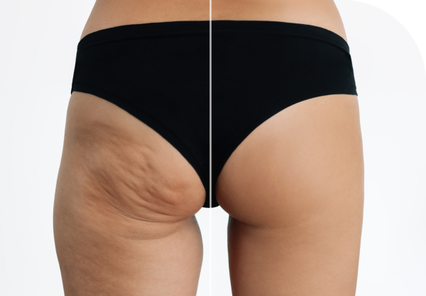 A before-and-after comparison image showing the highly effective results of Profhilo body treatment on the buttocks and upper thighs, with the skin appearing significantly smoother and firmer on the 'after' side.