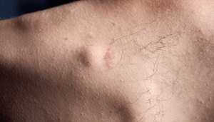 is Lipoma Dangerous