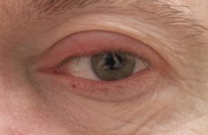 A close-up photograph of a person's eye exhibiting crepey eyelids, characterised by thin, loose, and wrinkled skin on both the upper and lower lids.