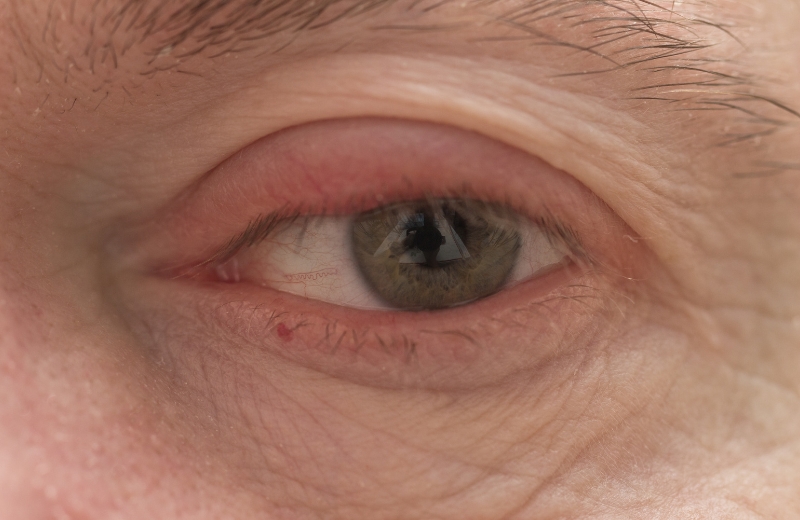 A close-up photograph of a person's eye exhibiting crepey eyelids, characterised by thin, loose, and wrinkled skin on both the upper and lower lids.