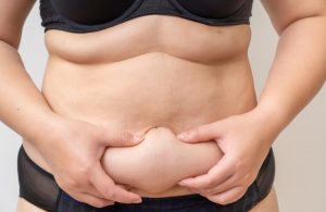 Person holding flabby skin on the lower stomach, highlighting loose abdominal skin.