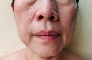 Close-up of the lower face of a middle-aged person showing visible sagging skin and fine lines around the mouth and jaw area.