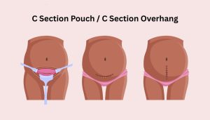 Illustration showing a C-Section pouch and C section overhang, highlighting abdominal changes and scar placement after caesarean delivery.