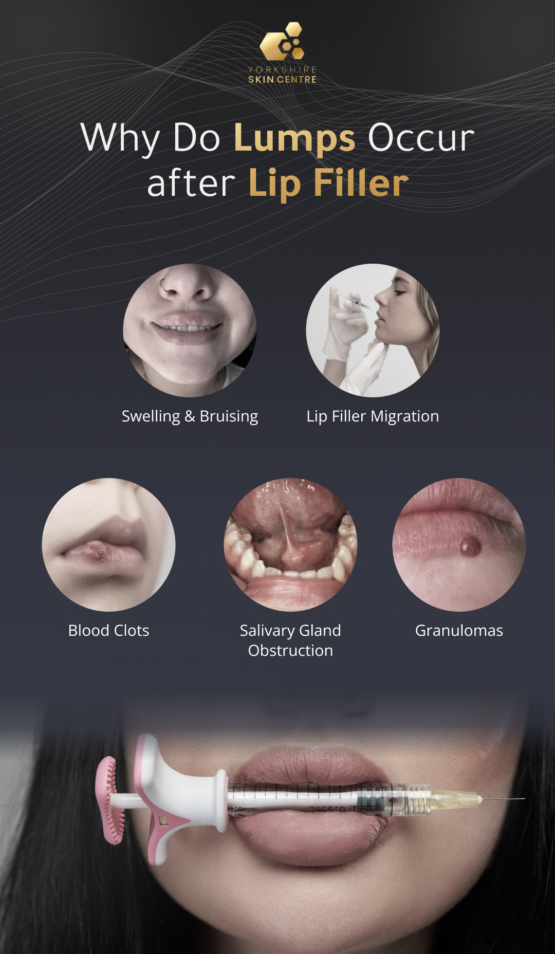 Causes of lump inside lip after filler shown in a medical infographic