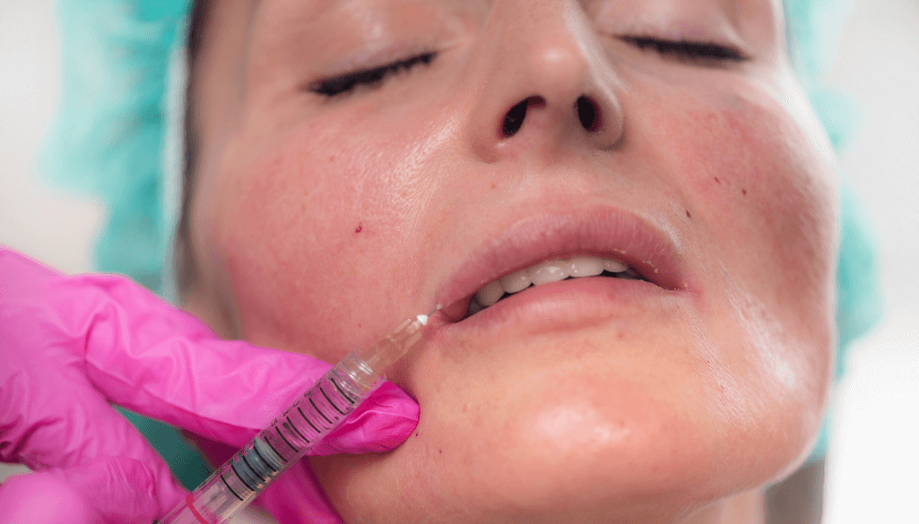 Lumps inside the lips can occur after filler due to swelling, product placement, or healing response.