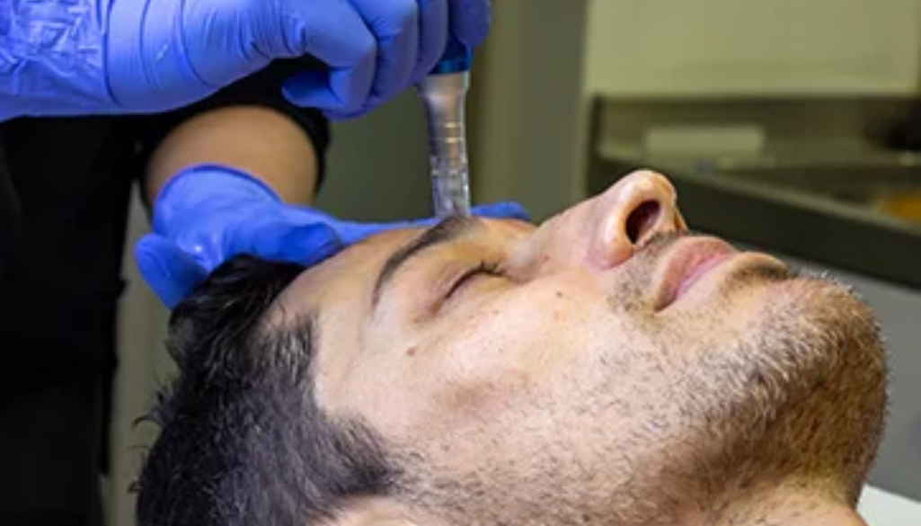 Microneedling procedure using a dermapen to improve skin texture