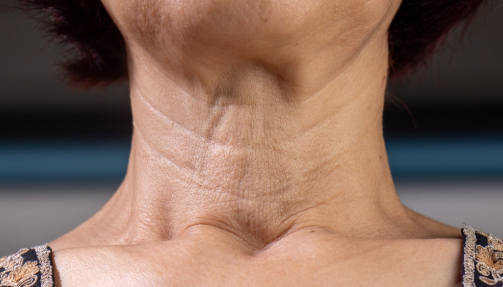 Ozempic Neck: What It Is, Why It Happens, and How to Fix It Naturally