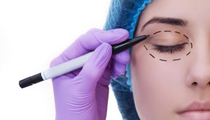 Surgeon marking the upper eyelid before surgery, illustrating preparation and safety considerations for blepharoplasty.