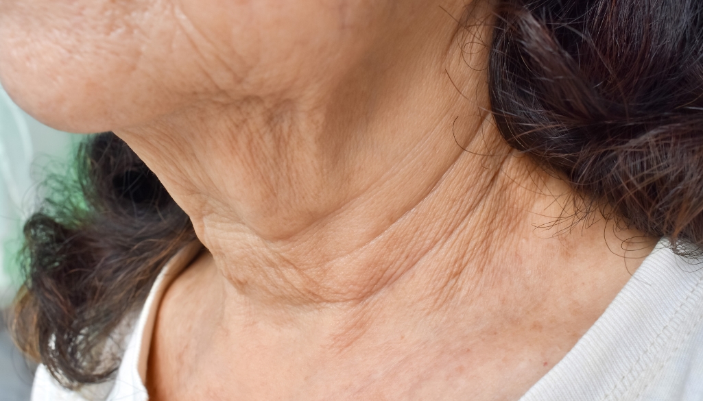 Close-up of ageing skin showing horizontal lines and creases commonly associated with neck wrinkles.