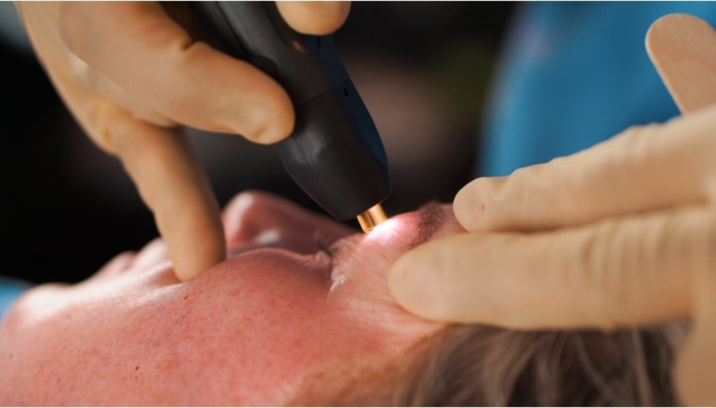 NeoGen Plasma skin resurfacing treatment being performed to improve skin texture and reduce wrinkles