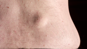 Small lipoma on the lower back appearing as a soft, rounded fatty lump under the skin
