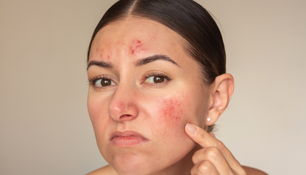 Types of Skin Lesions: Causes, Treatments, and More