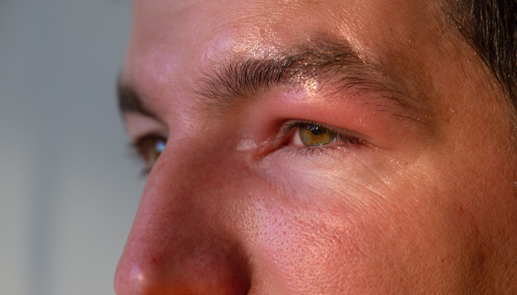 Swollen Eyelid: What It Is, Causes & Treatments