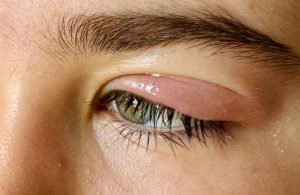 Close-up of a mildly swollen eyelid with redness, often raising the question of how long a swollen eyelid lasts.