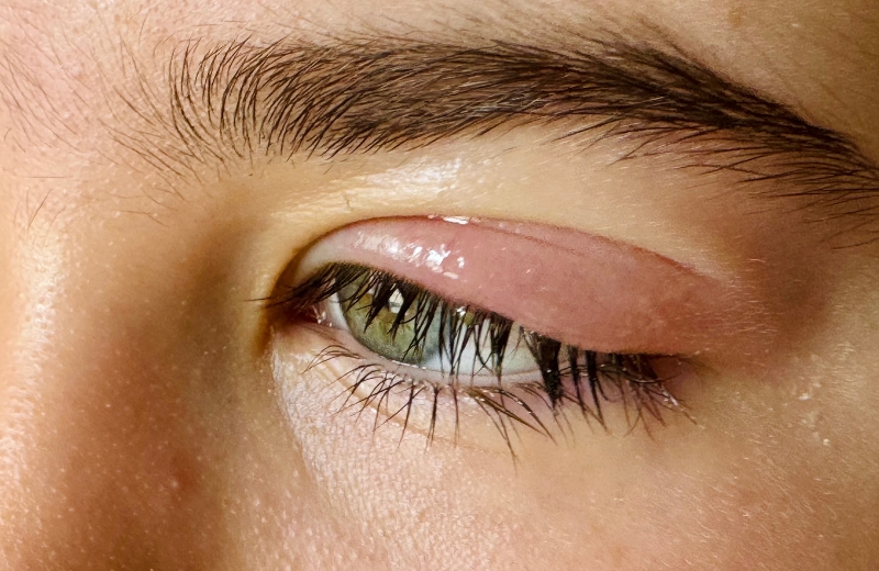How Long Does a Swollen Eyelid Last?